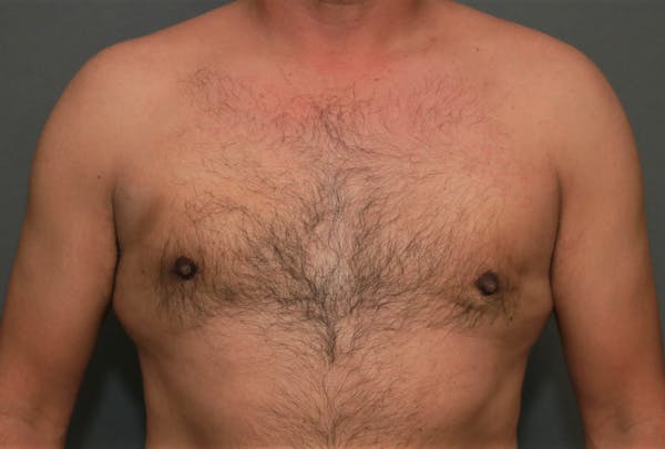 Gynecomastia Before & After Gallery - Patient 8284596 - Image 2