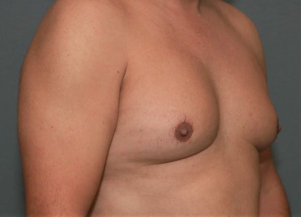 Gynecomastia Before & After Gallery - Patient 8284596 - Image 3