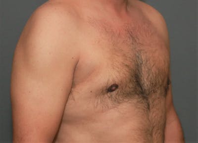 Gynecomastia Before & After Gallery - Patient 8284596 - Image 4