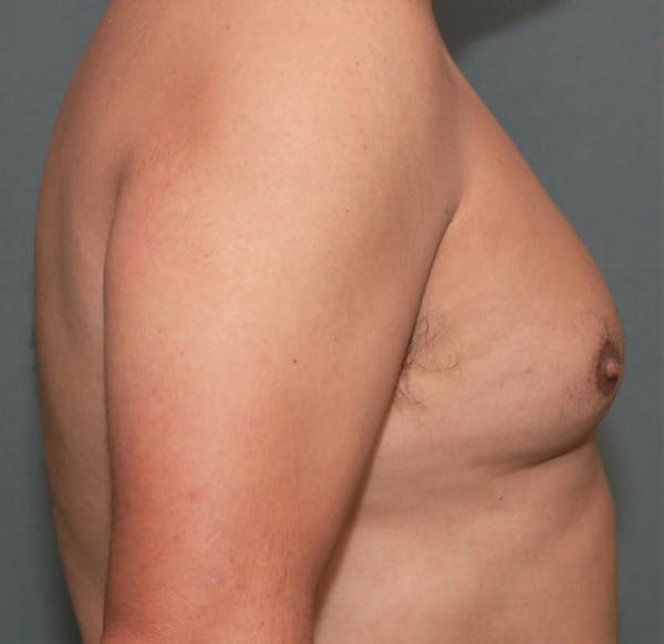 Gynecomastia Before & After Gallery - Patient 8284596 - Image 5