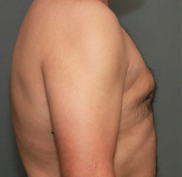 Gynecomastia Before & After Gallery - Patient 5157967 - Image 6