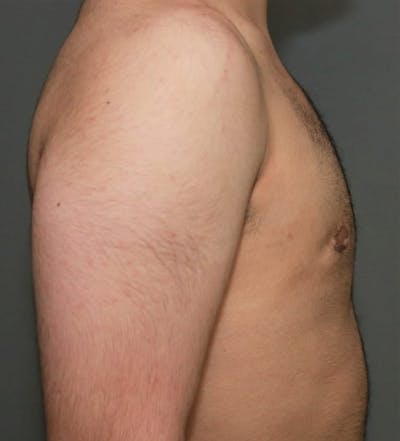 Gynecomastia Before & After Gallery - Patient 8284597 - Image 6
