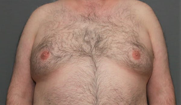 Gynecomastia Before & After Gallery - Patient 8284598 - Image 1