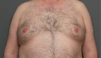 Gynecomastia Before & After Gallery - Patient 5157969 - Image 1