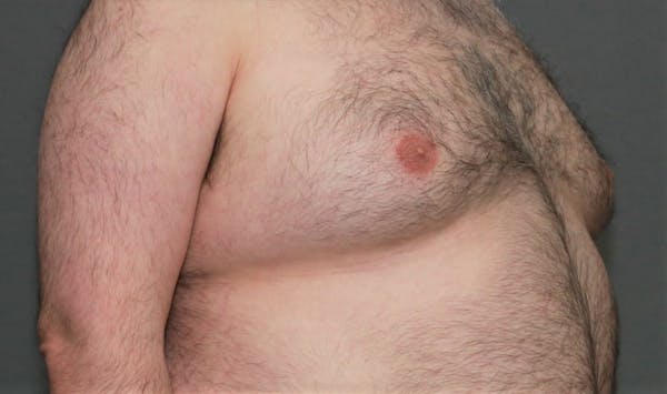Gynecomastia Before & After Gallery - Patient 8284598 - Image 3