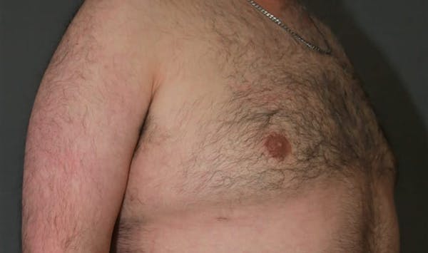 Gynecomastia Before & After Gallery - Patient 8284598 - Image 4