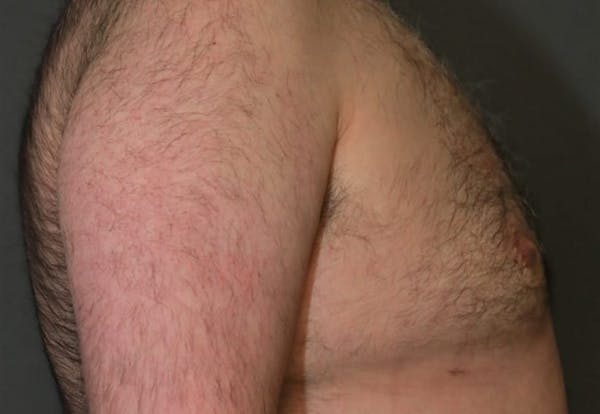 Gynecomastia Before & After Gallery - Patient 5157969 - Image 5