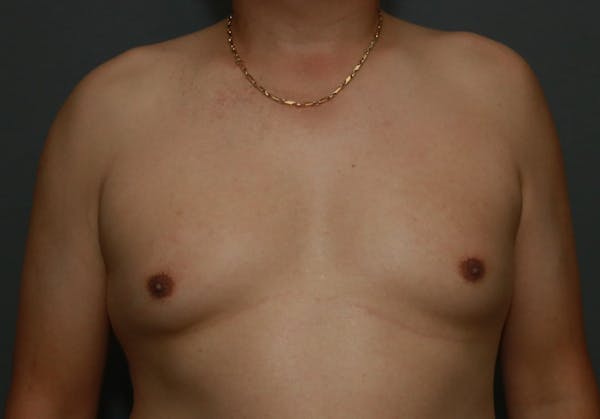 Gynecomastia Before & After Gallery - Patient 8284599 - Image 1