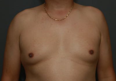 Gynecomastia Before & After Gallery - Patient 8284599 - Image 1