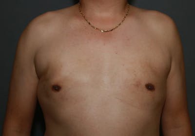 Gynecomastia Before & After Gallery - Patient 5157970 - Image 2