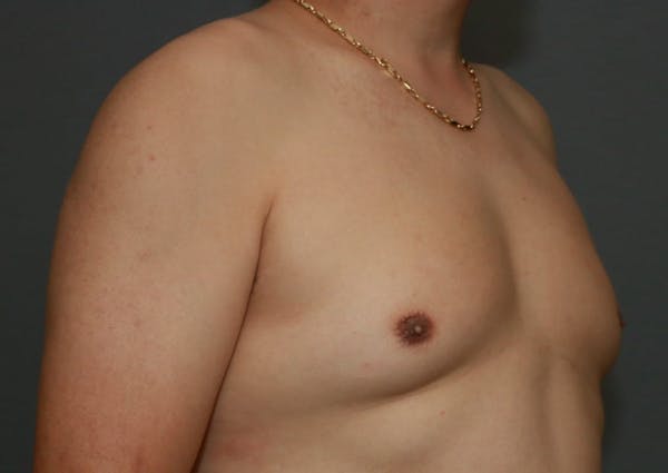 Gynecomastia Before & After Gallery - Patient 8284599 - Image 3