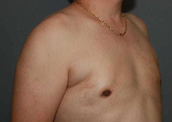 Gynecomastia Before & After Gallery - Patient 8284599 - Image 4