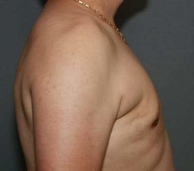 Gynecomastia Before & After Gallery - Patient 5157970 - Image 6