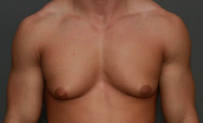 Gynecomastia Before & After Gallery - Patient 8284600 - Image 1