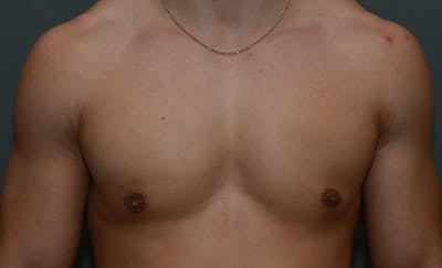 Gynecomastia Before & After Gallery - Patient 5157971 - Image 2