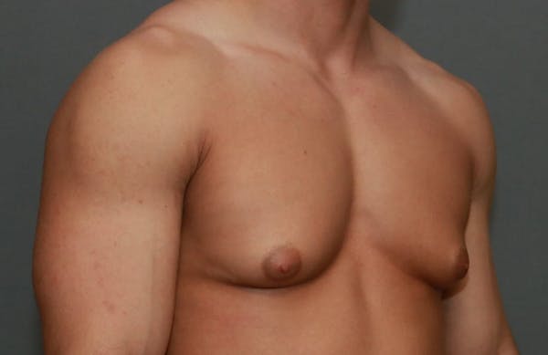 Gynecomastia Before & After Gallery - Patient 5157971 - Image 3