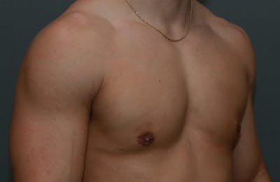 Gynecomastia Before & After Gallery - Patient 8284600 - Image 4