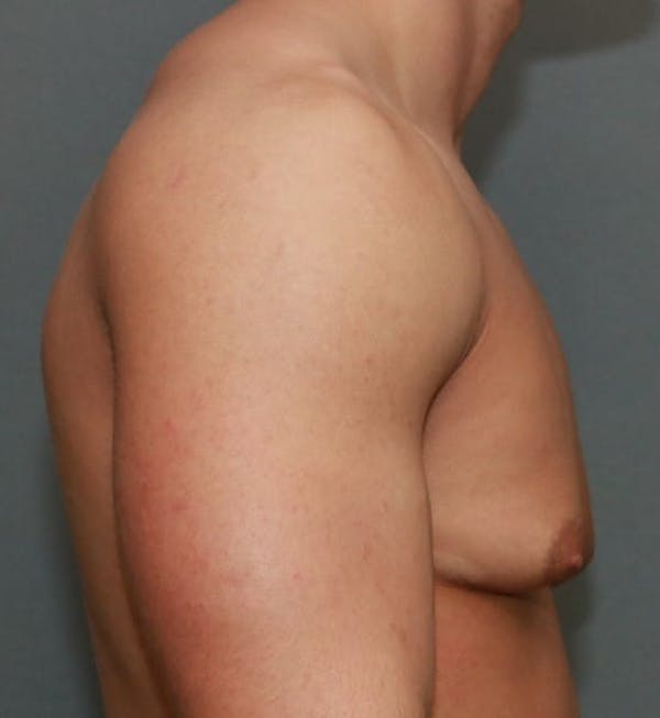 Gynecomastia Before & After Gallery - Patient 5157971 - Image 5