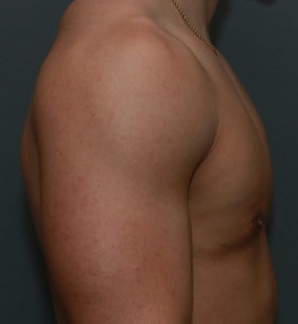 Gynecomastia Before & After Gallery - Patient 5157971 - Image 6