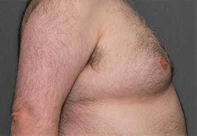 Gynecomastia Before & After Gallery - Patient 5157969 - Image 6