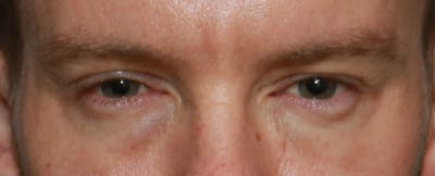 Lower Blepharoplasty Before & After Gallery - Patient 5158176 - Image 1
