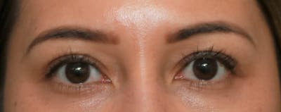 Upper Blepharoplasty Before & After Gallery - Patient 5158180 - Image 2