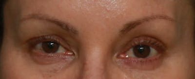 Upper Blepharoplasty Before & After Gallery - Patient 5158181 - Image 1