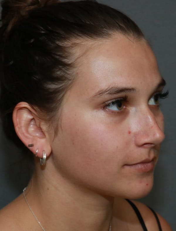 Aesthetic Rhinoplasty Before & After Gallery - Patient 5164567 - Image 3