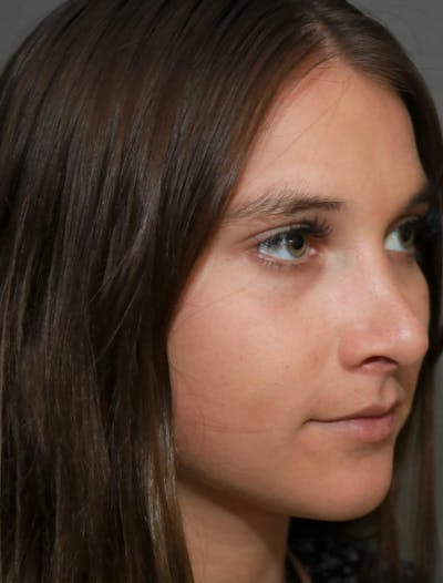 Aesthetic Rhinoplasty Before & After Gallery - Patient 5164567 - Image 4