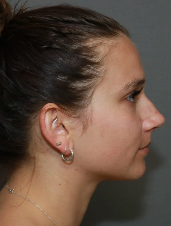 Aesthetic Rhinoplasty Before & After Gallery - Patient 5164567 - Image 5