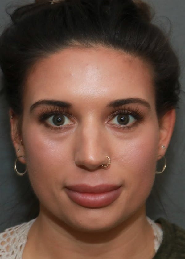 Aesthetic Rhinoplasty Before & After Gallery - Patient 5164568 - Image 1