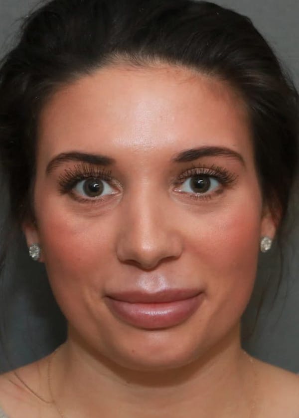Aesthetic Rhinoplasty Before & After Gallery - Patient 5164568 - Image 2