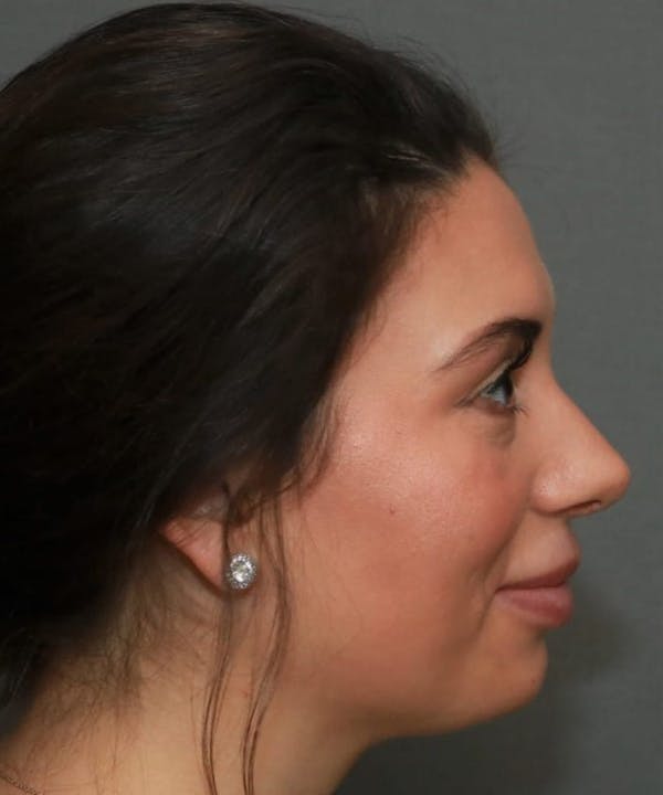Aesthetic Rhinoplasty Before & After Gallery - Patient 5164568 - Image 6