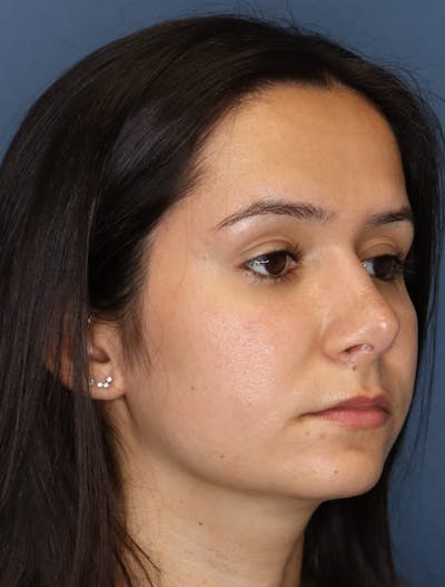 Aesthetic Rhinoplasty Before & After Gallery - Patient 5164569 - Image 4