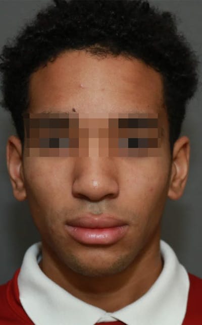 Functional Rhinoplasty Before & After Gallery - Patient 5164605 - Image 2