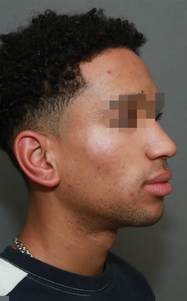 Functional Rhinoplasty Before & After Gallery - Patient 5164605 - Image 3