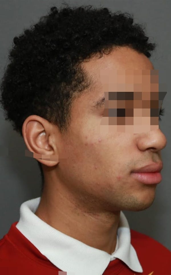 Functional Rhinoplasty Before & After Gallery - Patient 5164605 - Image 4