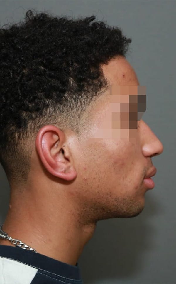 Functional Rhinoplasty Before & After Gallery - Patient 5164605 - Image 5