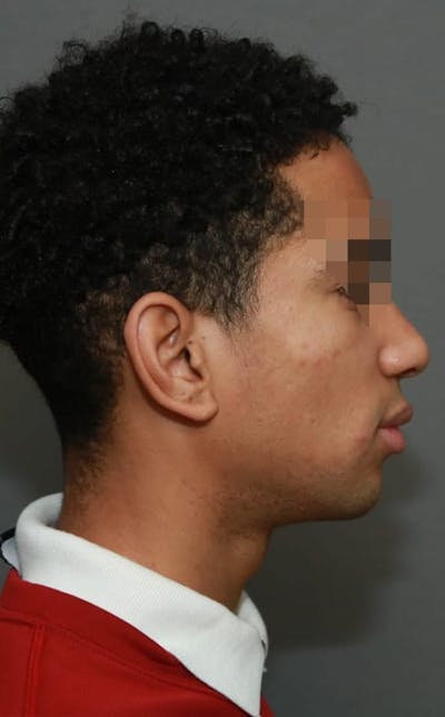 Functional Rhinoplasty Before & After Gallery - Patient 5164605 - Image 6