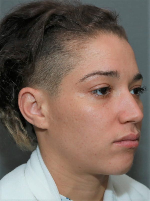 Functional Rhinoplasty Before & After Gallery - Patient 5164606 - Image 3