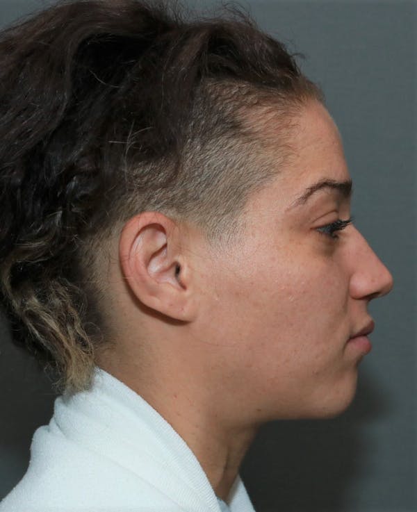 Functional Rhinoplasty Before & After Gallery - Patient 5164606 - Image 5