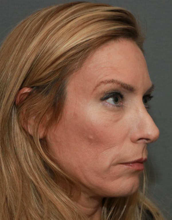 Revision Rhinoplasty Before & After Gallery - Patient 5164617 - Image 3