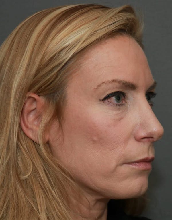 Revision Rhinoplasty Before & After Gallery - Patient 5164617 - Image 4
