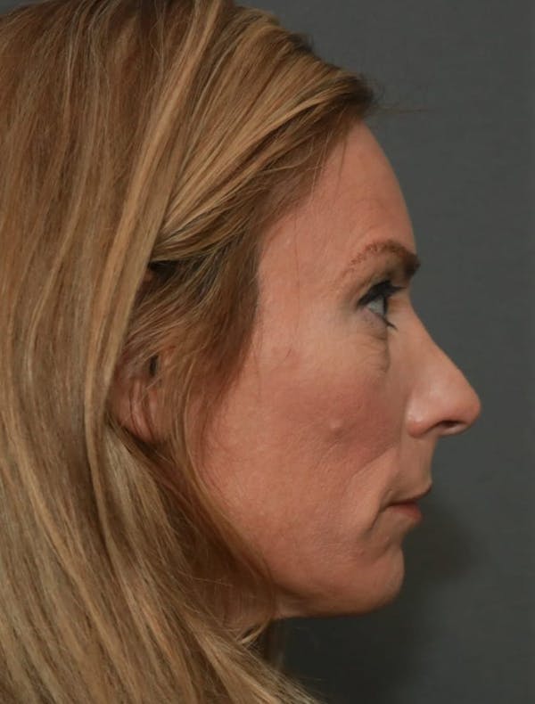 Revision Rhinoplasty Before & After Gallery - Patient 5164617 - Image 5