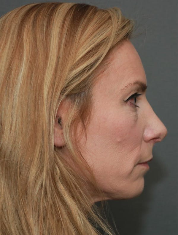 Revision Rhinoplasty Before & After Gallery - Patient 5164617 - Image 6
