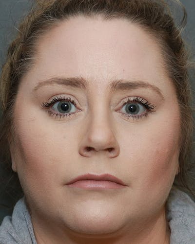 Aesthetic Rhinoplasty Before & After Gallery - Patient 5282749 - Image 2