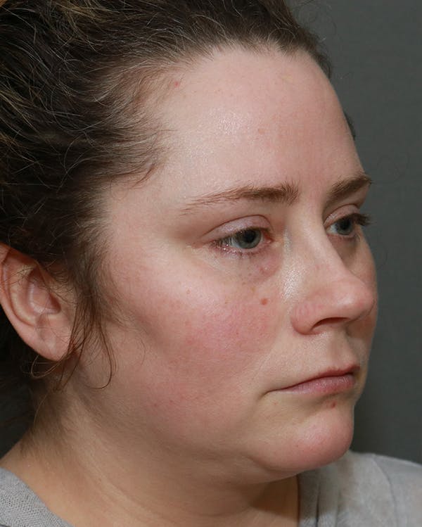 Aesthetic Rhinoplasty Before & After Gallery - Patient 5282749 - Image 3