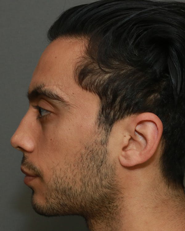Functional Rhinoplasty Before & After Gallery - Patient 5282751 - Image 5