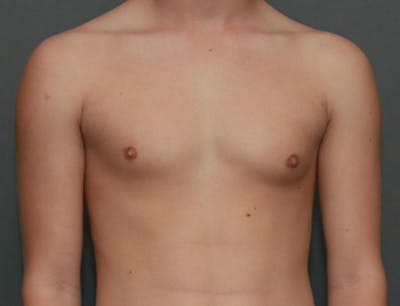 Gynecomastia Before & After Gallery - Patient 8284602 - Image 1
