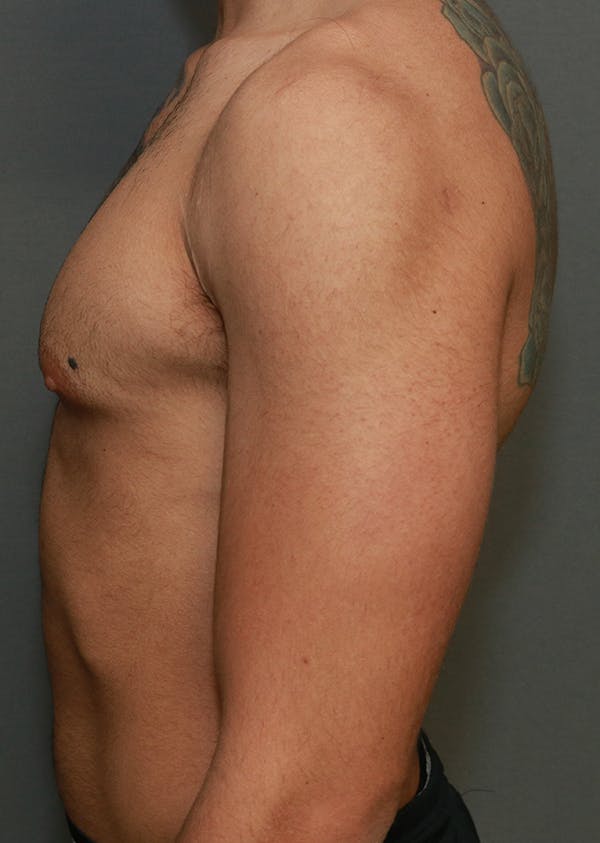 Gynecomastia Before & After Gallery - Patient 5282757 - Image 5